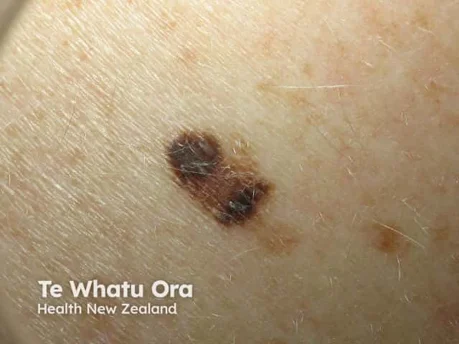 Melanoma - look for asymmetry