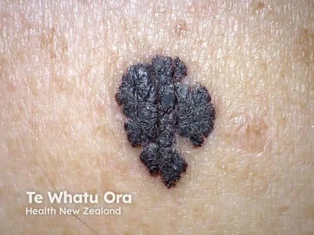 Melanoma - look for border irregularity