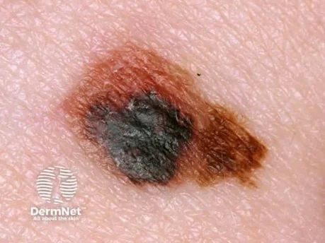 Melanoma - look for uneven colour