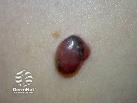 Melanoma - look for firmness