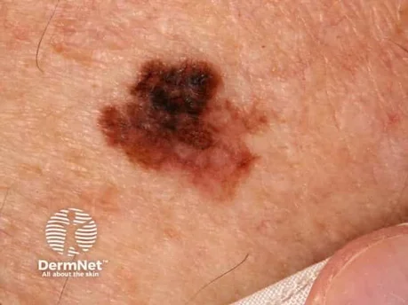 Melanoma - is it evolving?