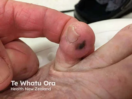 Melanoma - is it growing?